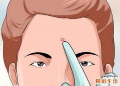 白头粉刺可以挤吗