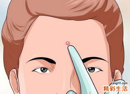 白头粉刺可以挤吗