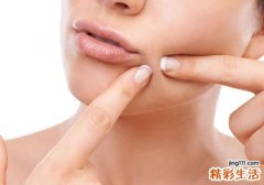 女性粉刺是怎么形成的 这几点要注意