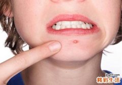 长了粉刺应该怎么处理 9个去除粉刺的小妙招