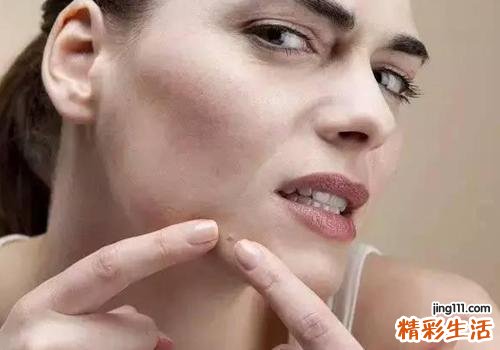 粉刺是怎么形成的 这些都会让你长粉刺
