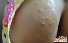 坐久了屁股上长疙瘩怎么办