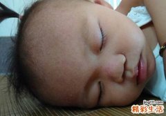 宝宝夏天怎么防痱子 这些防“痱”小窍门可以用