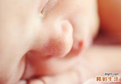 花露水对痱子有用吗 起痱子能用花露水吗