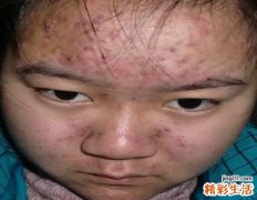 青春痘破了会不会留疤