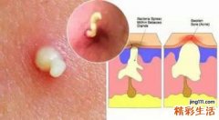 青春痘里面的白色物质是什么