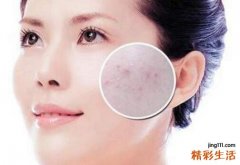 青春痘的治疗方法 远离青春痘？看部位从饮食调理开始