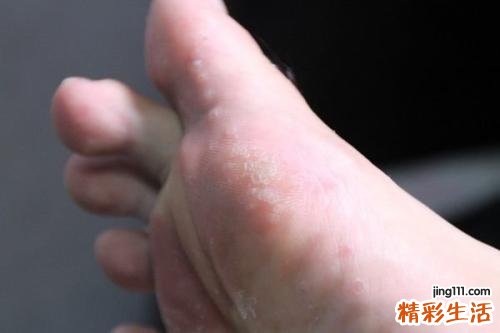脚气怎么治 做一个健康的没有脚气的人