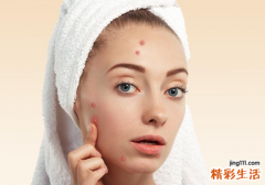 青春痘有哪些危害 别以为只是一个小痘