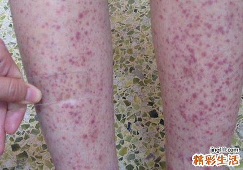 过敏性紫癜的症状