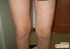 过敏性紫癜能治好吗