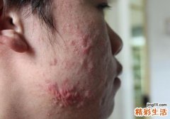 警惕！夏季皮肤病高发，该怎么调理呢