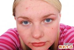 夏季容易得什么皮肤病？听听专家怎么说