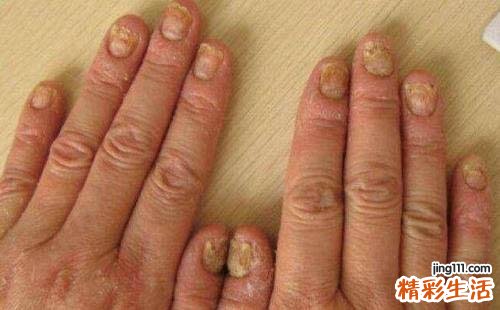 真菌皮肤病怎么治 用沙多谱分子碘