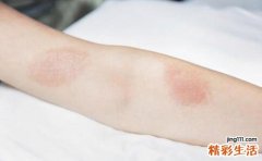 治疗皮肤病的注意事项 8点不可忽视
