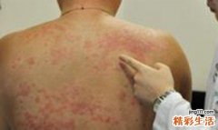 长癣是什么原因 癣的预防方法