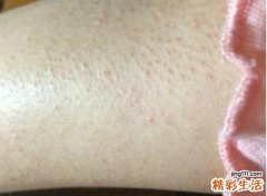 皮肤起小疙瘩是怎么回事啊 可能是身体出现这6个毛病