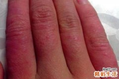 冻疮是什么原因引起的 冻疮的防与治