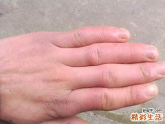 冬天怎么预防冻疮 防止冻疮复发