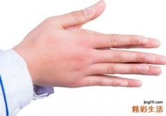 冬季容易发冻疮怎么办 如何预防冻疮