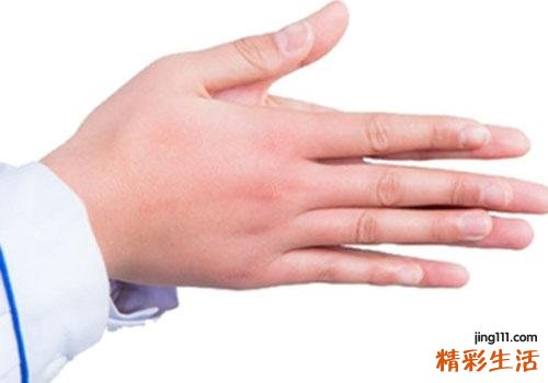 冬季容易发冻疮怎么办 如何预防冻疮