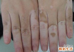 白斑风有什么症状