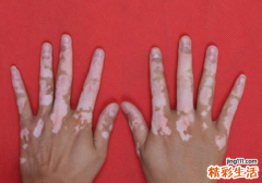 白癜风最有效治疗偏方 有没有效果用了才知道