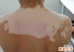 白癜风能吃哪些水果 这些水果白癜风患者必不可少