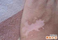 白癜风会遗传给孩子吗 白癜风的父母必须知道这些
