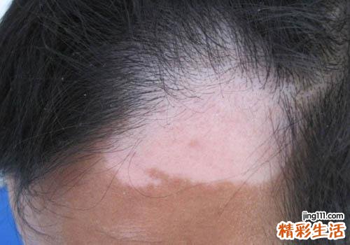 怎样补黑色素治白癜风 这些方法必不可少