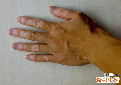 白癜风怎么治疗 九种方法让你告别白癜风