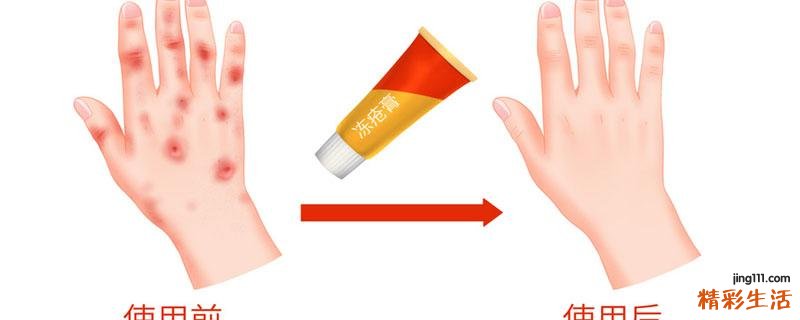 冻疮不痒不痛怎么回事 冻疮什么样是快要好了