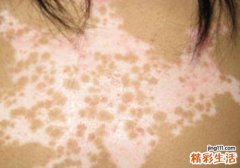 白癜风症状