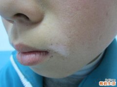 白癜风不能吃什么