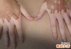 白癜风偏方