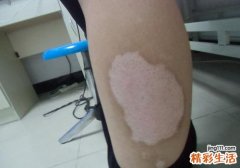 白癜风如何预防