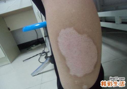 白癜风如何预防