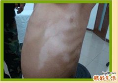 白癫风要注意什么