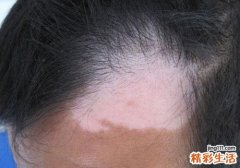 白癜风能治好吗