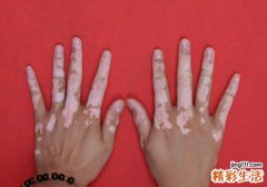 白癜风传染吗