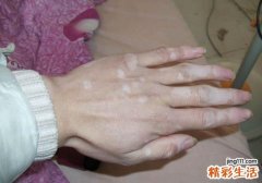 白癜风会不会传染 看完这些不再惧怕白癜风患者