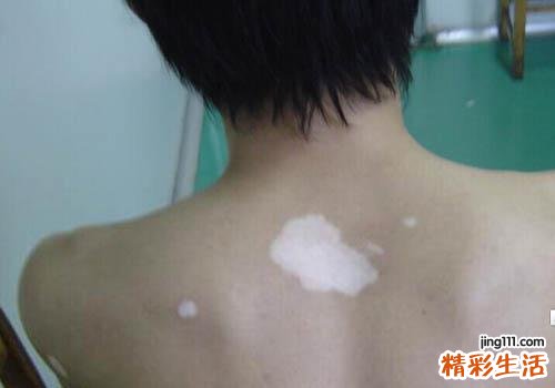 白癜风早期能治愈吗 看完这些你还会担心吗
