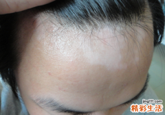 手上的白癜风能治好吗 手上白癜风为什么难治愈