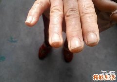 灰指甲擦醋有效果吗 灰指甲擦陈醋的方法