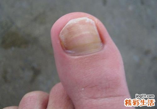 灰指甲如何传染给别人 看看这些你就明白了