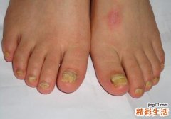 灰指甲是怎么引起的 这些原因你知道吗