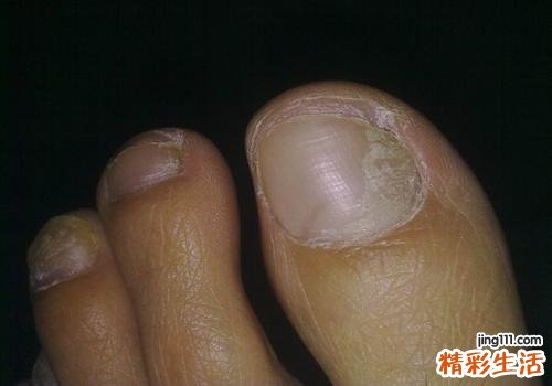 灰指甲不治疗的后果 看完后果千万要马上治疗