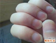 灰指甲传染吗 容易感染灰指甲的人群