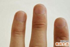 灰指甲早期症状 灰指甲的初期症状都有哪些