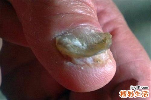 如何预防灰指甲 诱发灰指甲的原因